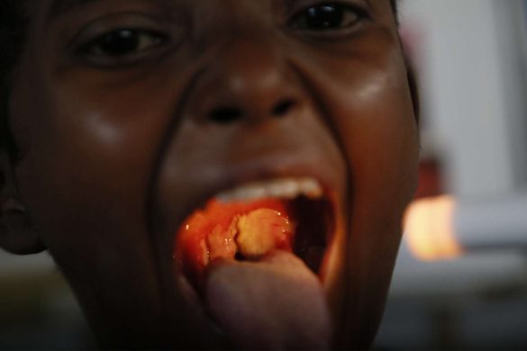 Diphtheria Symptoms
